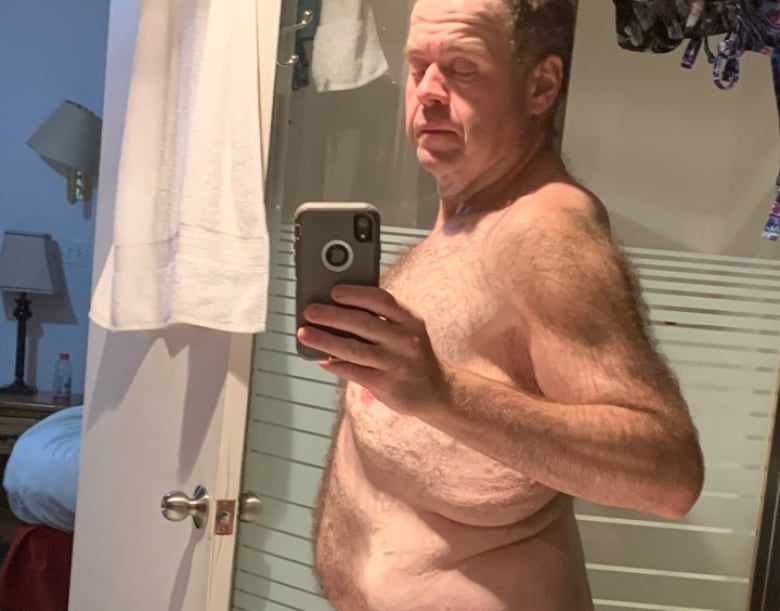 A man takes a selfie in front of a bathroom mirror to show folds of loose skin after major weight loss. 