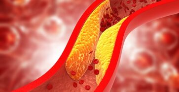 Chattanooga doctor gives recommendations on preventing plaque buildup in arteries
