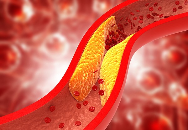 Chattanooga doctor gives recommendations on preventing plaque buildup in arteries