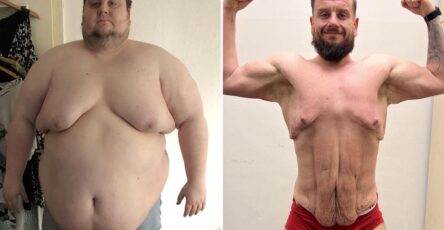I lost 350 lbs - now I'm not depressed anymore