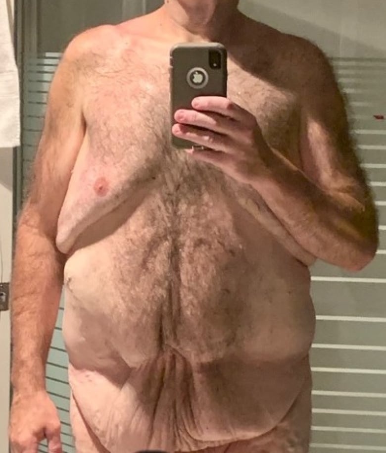 Front view of shirtless man taking photo of himself, showing low skin folds in lower abdomen. 