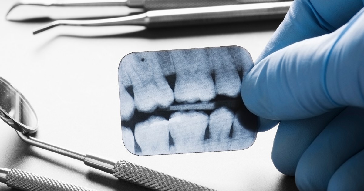 Millions Set To Lose Dental Coverage After Medicaid Review