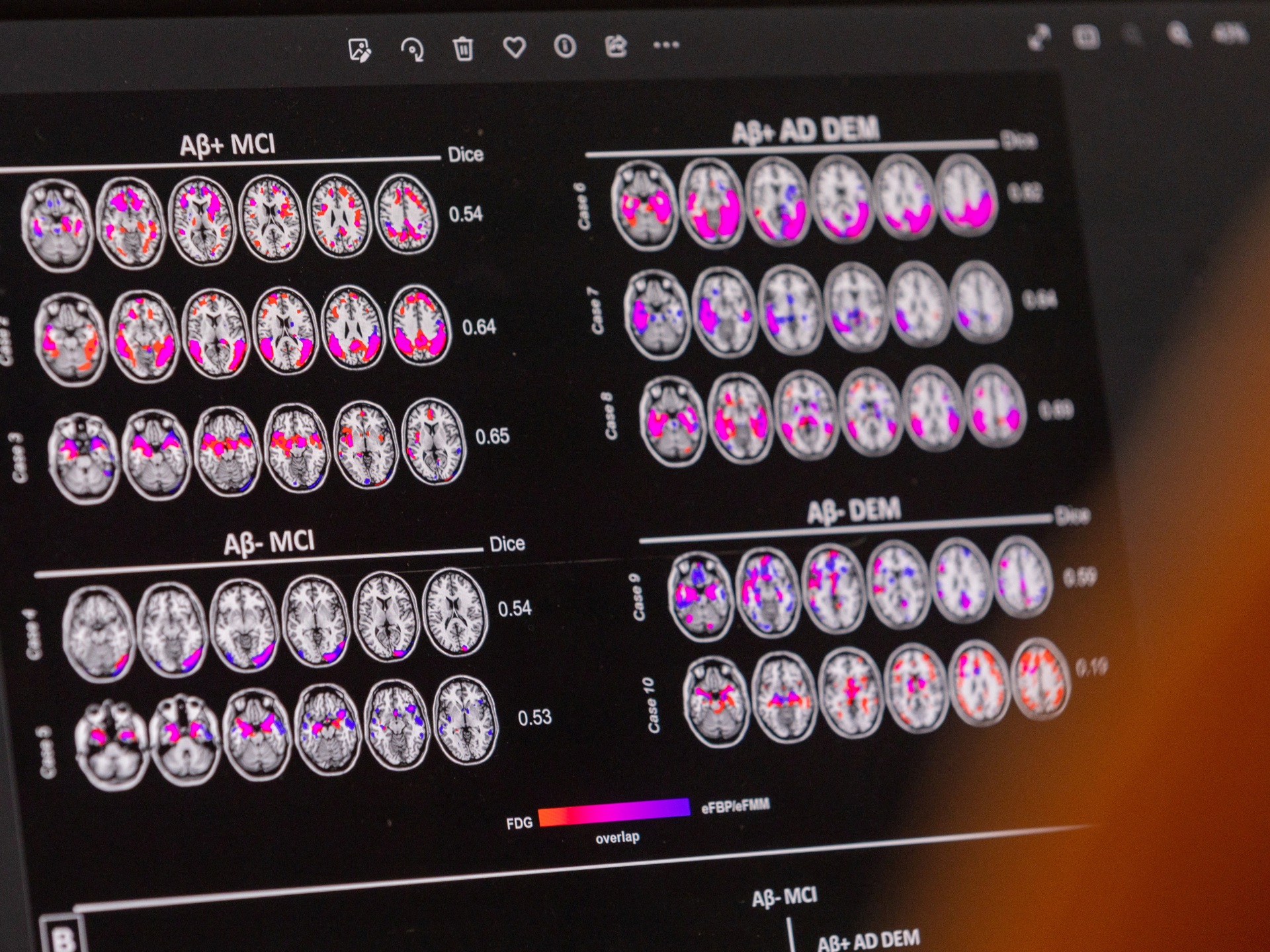US government approves Alzheimer's drug to slow cognitive decline |  Health info